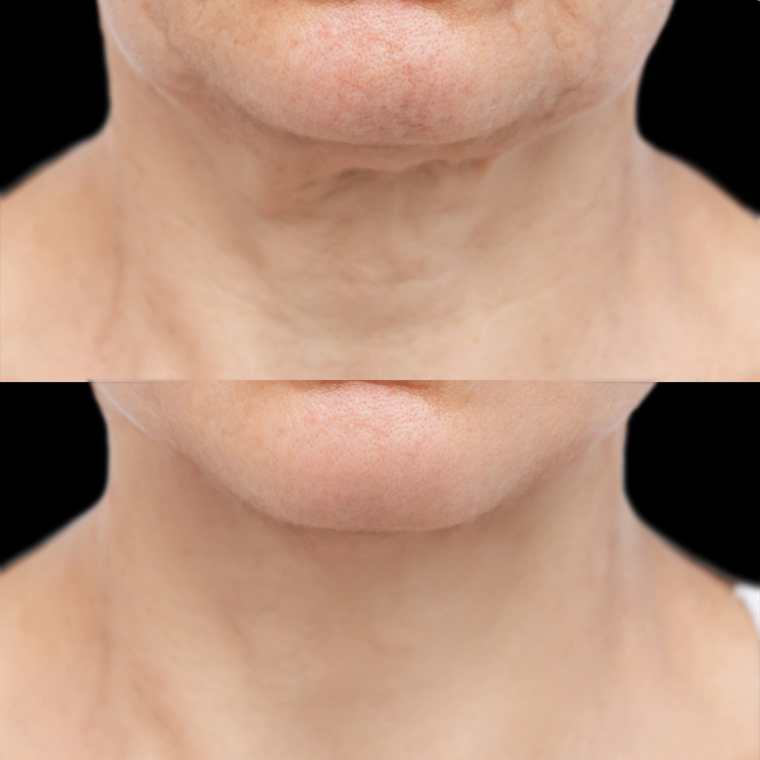 Neck lift 3