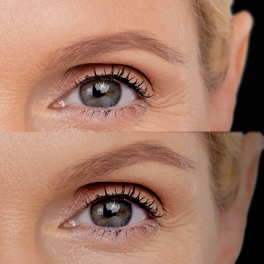 brow lift ba 1
