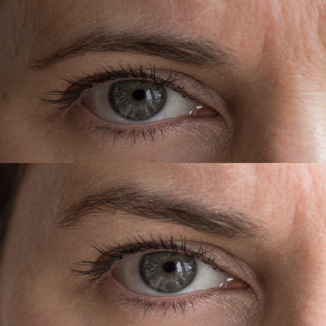 brow lift ba 2
